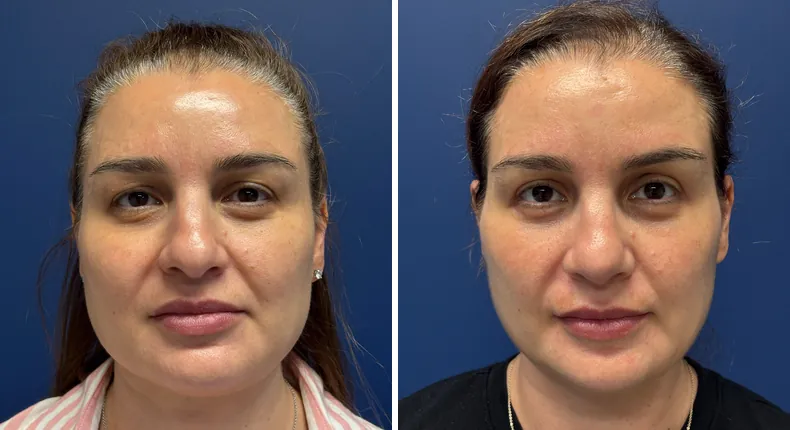 Before and after facelift: patient's face, with facial fat grafting
