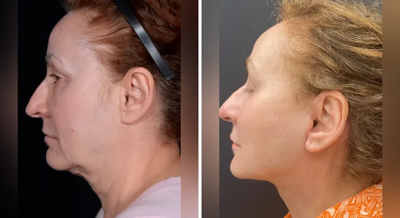 Before and after facelift: patient's face in left profile, with neck lift
