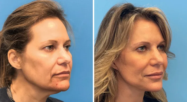 Before and after facelift: patient's face at a right angle