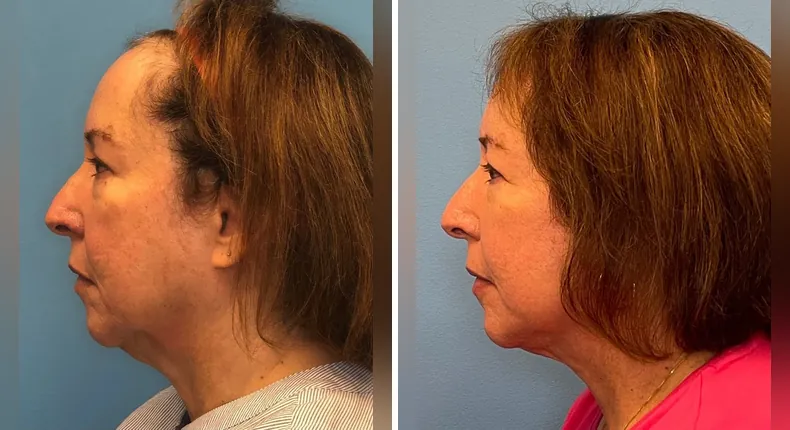 Before and after facelift: woman's face from the left side