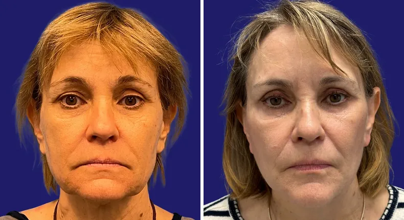 Before and after facelift: woman's face from the front, with arm lift