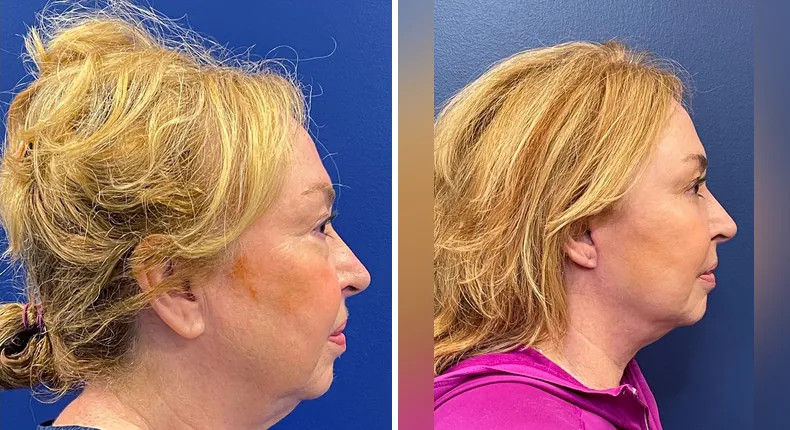 Before and after facelift: woman's face from the right side