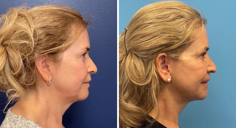 Before and after facelift: patient's face from the right side