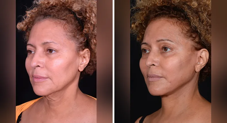 Before and after facelift: patient's face at a left angle