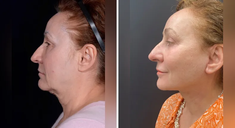Before and after facelift: patient's face from the left side