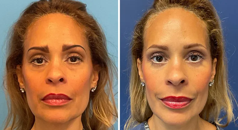 Before and after facelift: patient's face from the front, with facial fat grafting