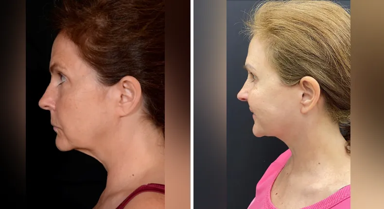 Before and after facelift: patient's face in left profile, with neck lift and Face360