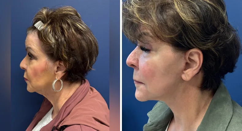 Before and after facelift: patient's face