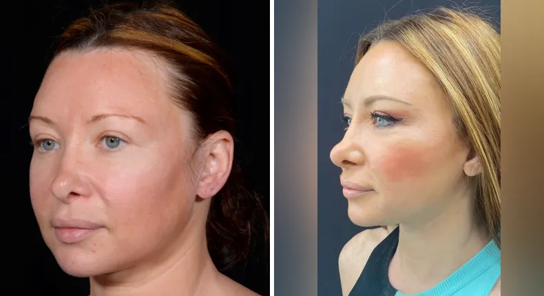 Before and after facelift: patient's face at a left angle, with facial fat grafting