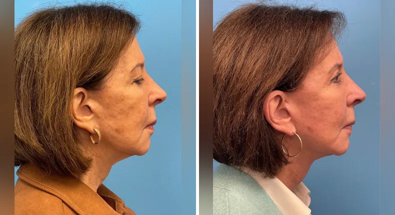 Before and after facelift: woman's face from the right side