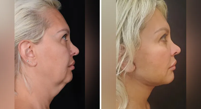 Before and after facelift: patient's face from the right side