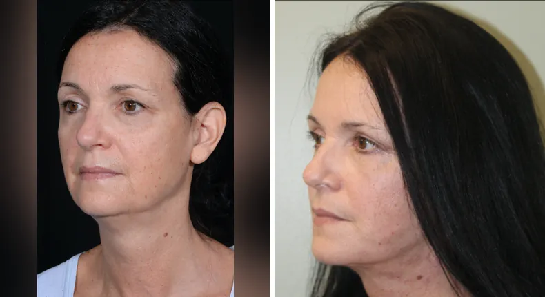 Before and after facelift: patient's face at a left angle, with neck lift