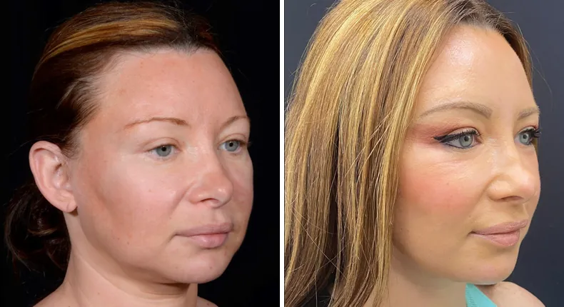 Before and after facelift: patient's face at a right angle, with facial fat grafting