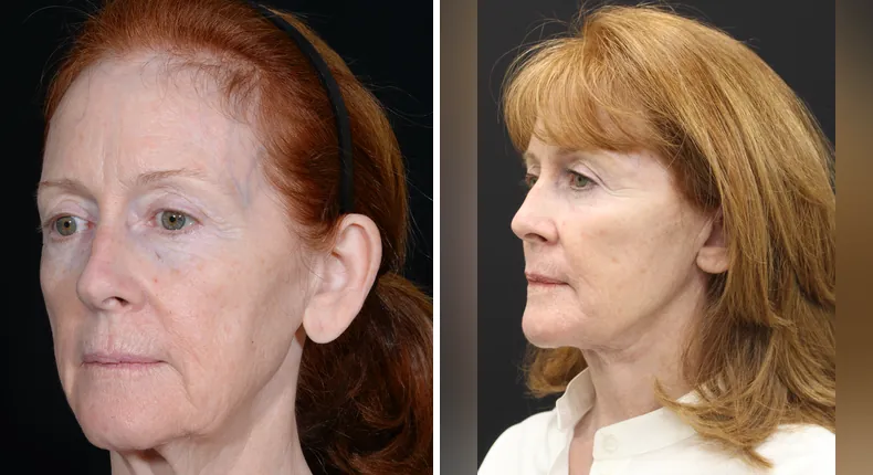 Before and after facelift: patient's face at a left angle, with neck lift