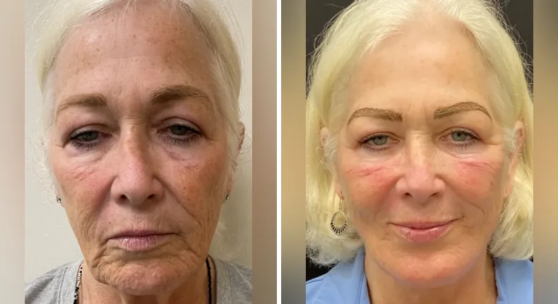 Before and after facelift: patient's face from the front, with neck lift