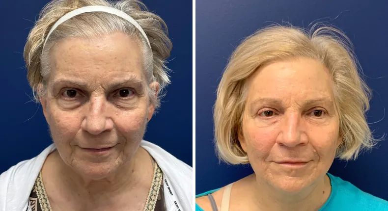 Before and after facelift: patient's face