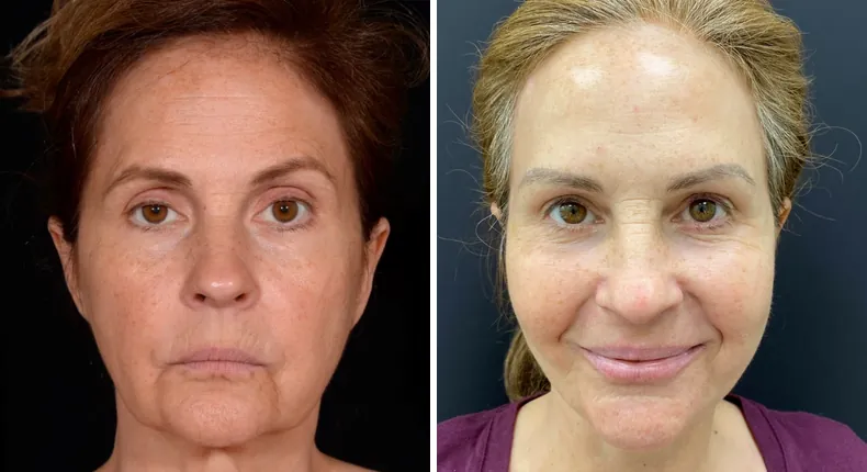 Before and after facelift: patient's face from the front, with neck lift and Face360
