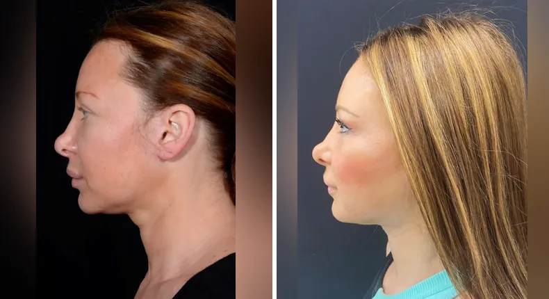Before and after facelift: patient's face in left profile, with facial fat grafting