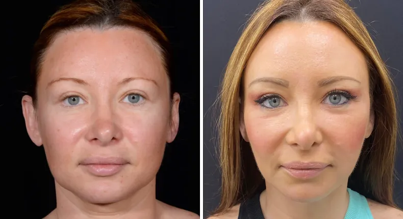 Before and after facelift: patient's face from the front, with facial fat grafting