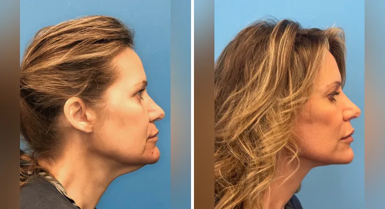 Before and after facelift: patient's face from the right side