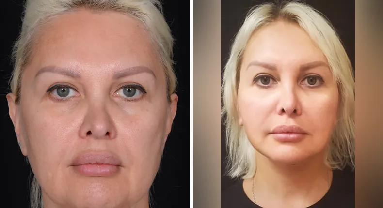 Before and after facelift: patient's face from the front