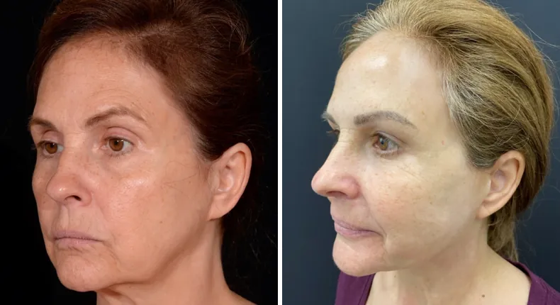 Before and after facelift: patient's face at a left angle, with neck lift and Face360