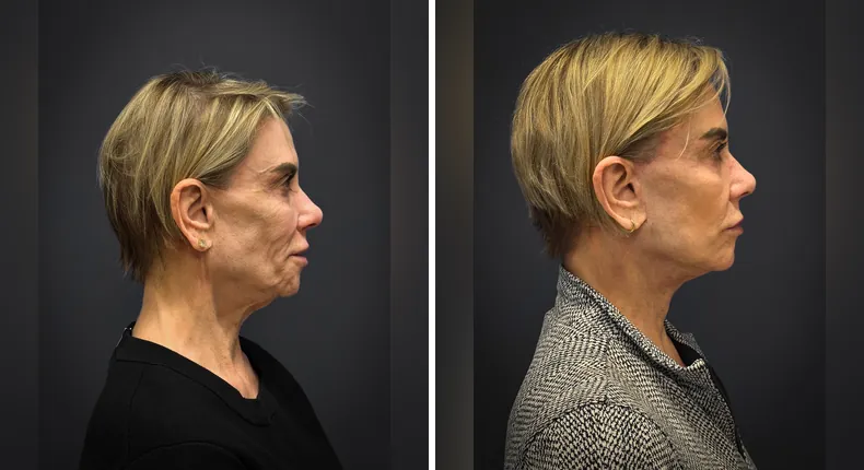 Before and after facelift: patient's face from the right side