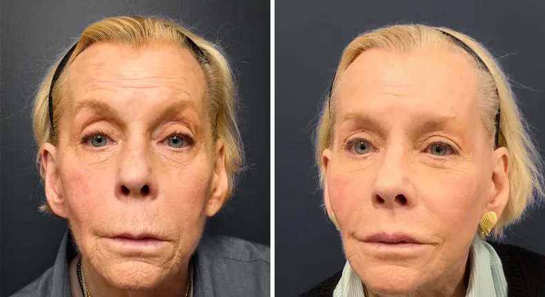 Before and after facelift: patient's face from the front