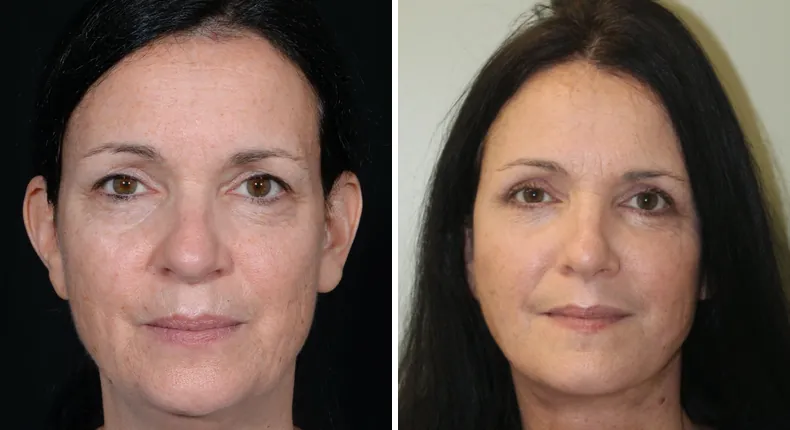Before and after facelift: patient's face from the front, with neck lift