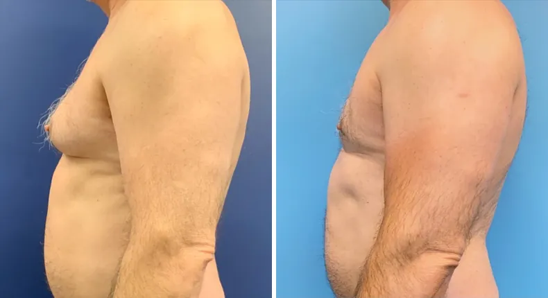 Before and after gynecomastia / male breast reduction: man's chest from the left side