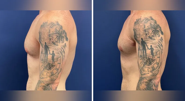 Before and after gynecomastia / male breast reduction: man's chest in left profile