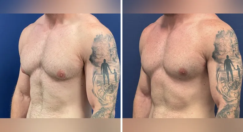 Before and after gynecomastia / male breast reduction: man's chest at a left angle