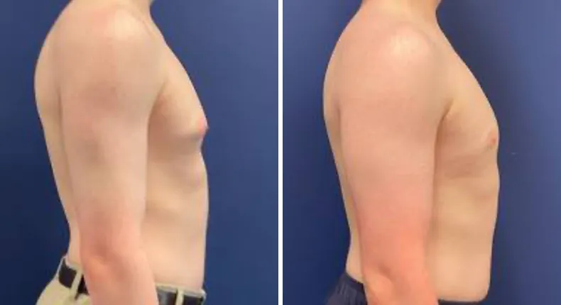 Before and after gynecomastia / male breast reduction: man's chest from the right side