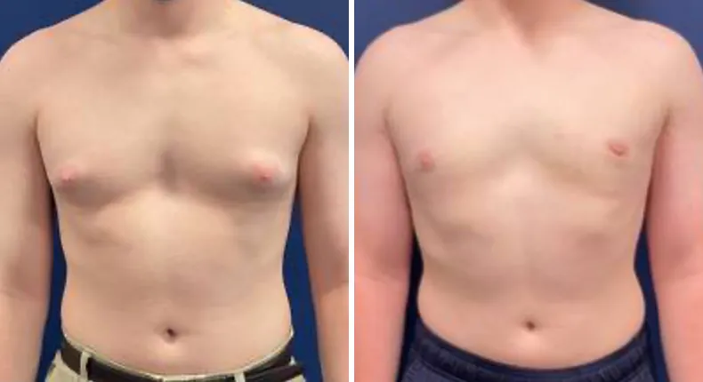 Before and after gynecomastia / male breast reduction: man's chest from the front