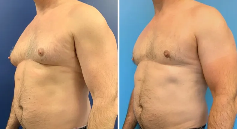 Before and after gynecomastia / male breast reduction: man's chest at a left angle