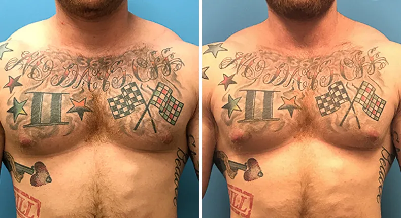 Before and after gynecomastia / male breast reduction: man's chest