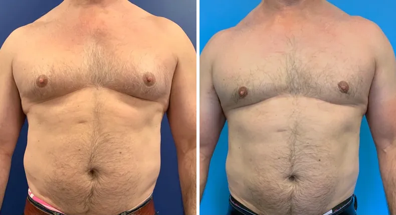 Before and after gynecomastia / male breast reduction: man's chest from the front