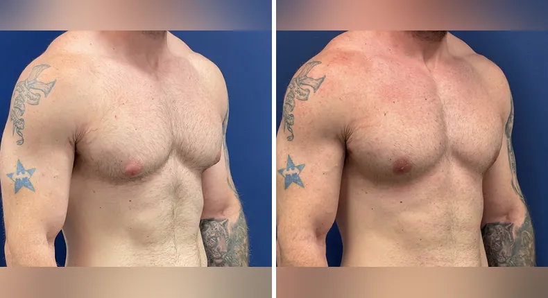 Before and after gynecomastia / male breast reduction: man's chest at a right angle