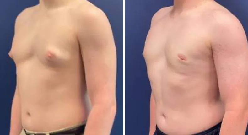 Before and after gynecomastia / male breast reduction: man's chest at a left angle