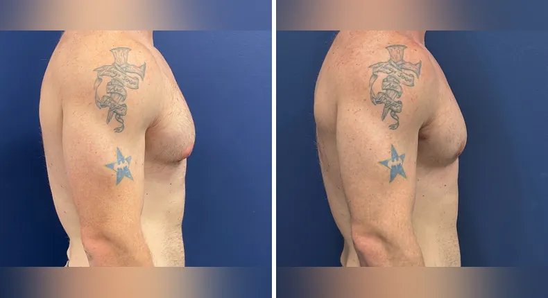 Before and after gynecomastia / male breast reduction: man's chest in right profile