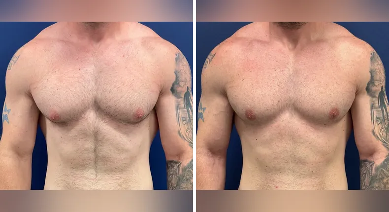 Before and after gynecomastia / male breast reduction: man's chest from the front