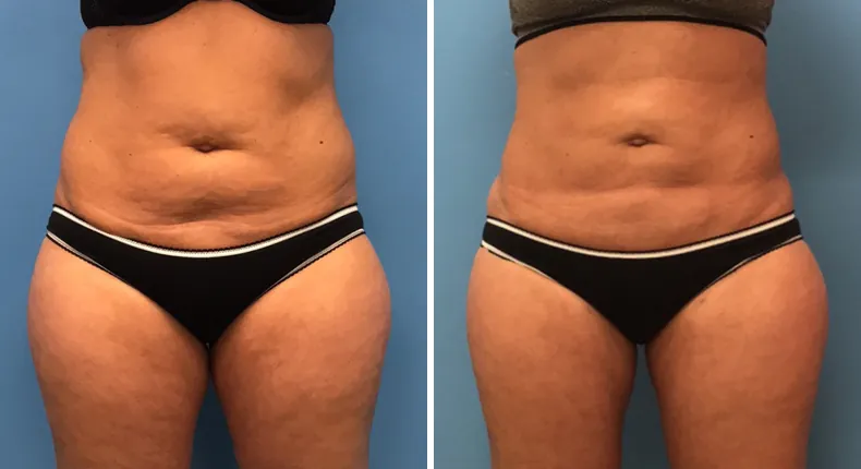 Before and after liposuction: woman's body from the front