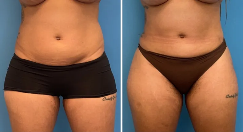 Before and after liposuction: woman's body from the front