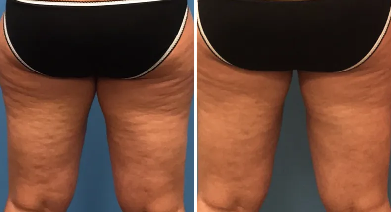 Before and after liposuction: patient's body from the back