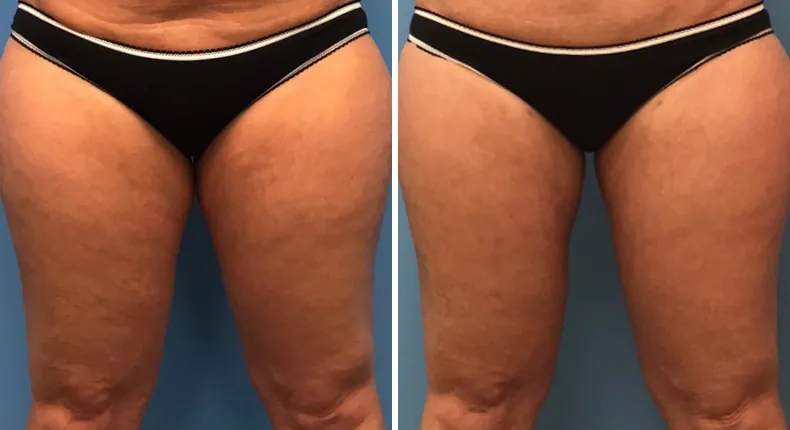 Before and after liposuction: patient's body from the front