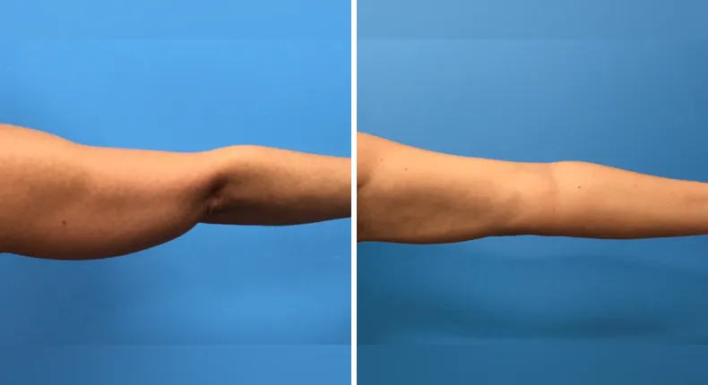 Before and after liposuction: patient's body from the back