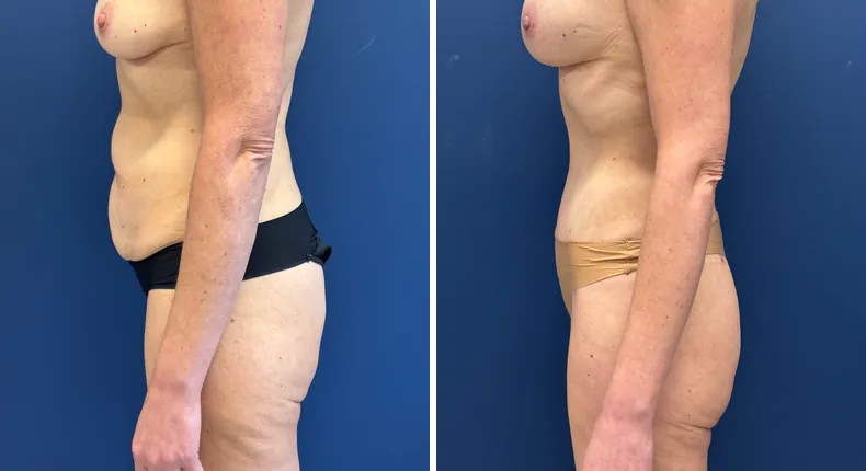 Before and after liposuction: patient's body from the left side