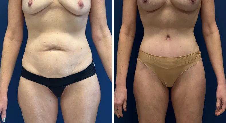 Before and after liposuction: patient's body
