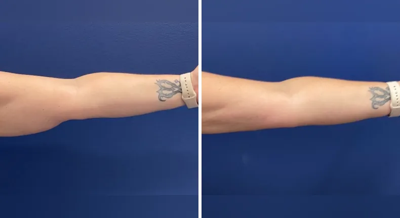 Before and after liposuction: patient's body from the right side