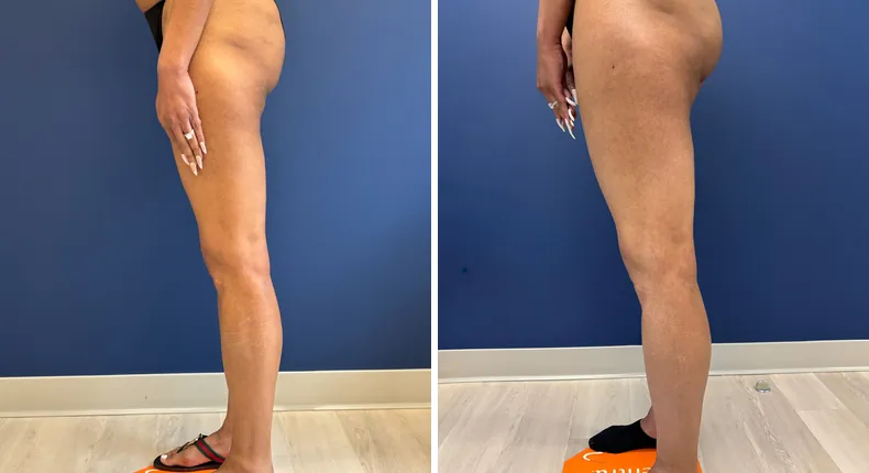 Before and after liposuction: patient's body from the left side
